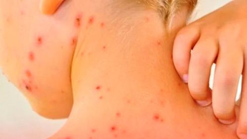 Hospital del niño en la paz activa alerta epidemiológica ante sospechas de sarampión