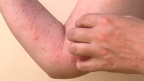 Santa Cruz confirma ocho casos de viruela del mono y evalúan 17 sospechosos