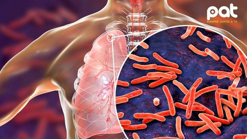 Pando enfrenta 34 casos de tuberculosis en lo que va del año