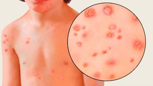 Potosí reporta aumento de casos de varicela e infecciones respiratorias