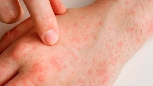 Primer caso de sarampión en Tarija activa bloqueo epidemiológico