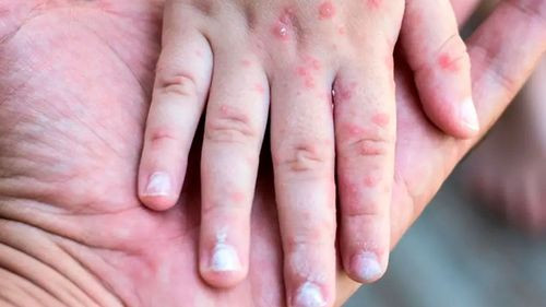 Suben a dos los casos de sarampión en Cochabamba este 2026