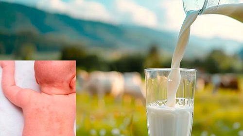 Entendiendo la alergia a la leche: Causas, síntomas y tratamiento