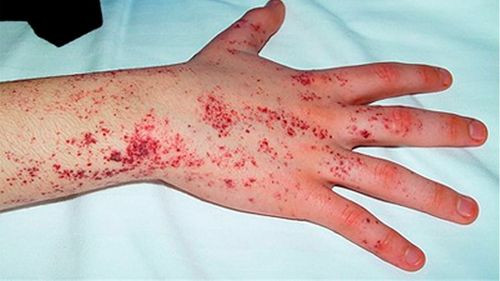 Enfermedad de Fabry: Importancia del diagnóstico temprano en el Día Mundial de las enfermedades poco frecuentes