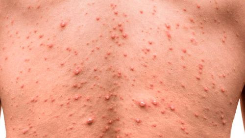 Sedes reporta ocho casos activos de viruela del mono en el departamento