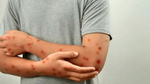 Sedes confirma dos casos de viruela del mono en santa cruz y activa la alerta epidemiológica 